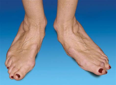 ортези при заболявания на ставите на краката